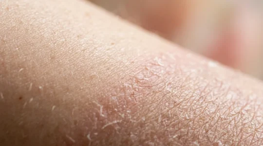 Close-up of healthy skin texture showing the healing process of skin barrier repair after over-exfoliation